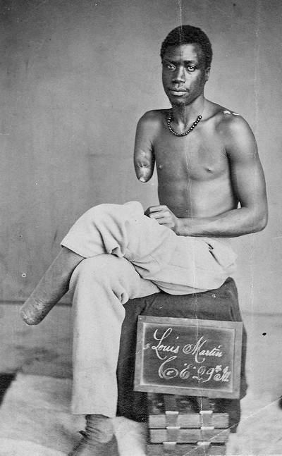 Lewis Martin - Blacks weren’t considered men, or citizens, yet, but they were allowed to fight in the Civil War in 1861. Lewis Martin was a member of the 29th U.S. Colored Infantry, and had to have his leg and arm amputated due to battle wounds accrued in the famous Battle of the Crater in July 1864.(Photo: National Archive)&nbsp;