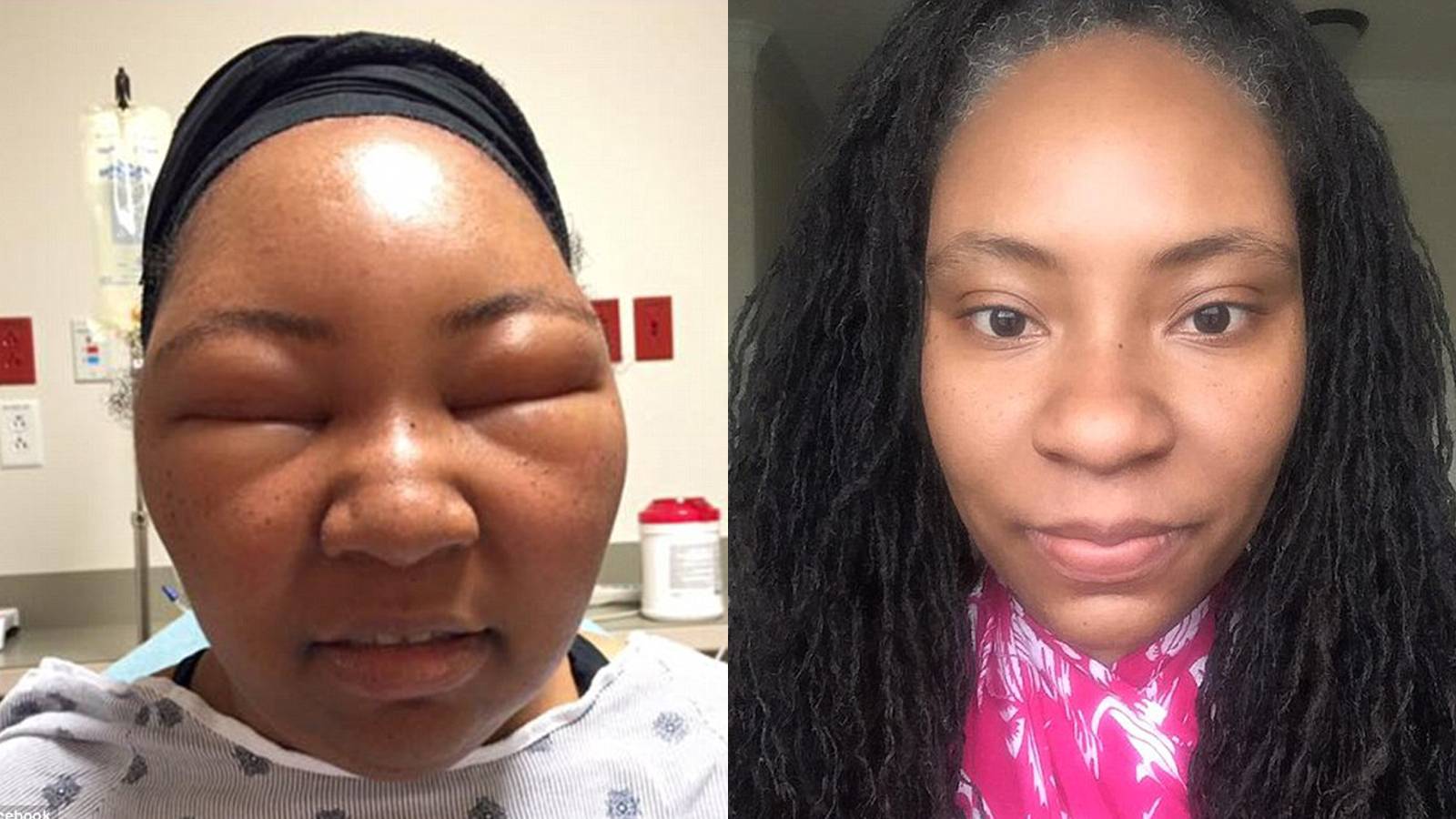 [look] Bloggers Eyes Are Swollen Shut After Allergic Reaction To Hair