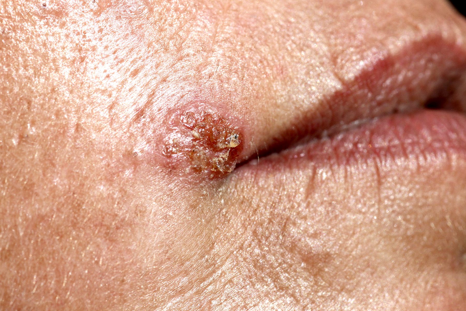 What Does Herpes Look Image 3 from The 411 on Herpes BET