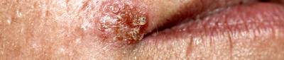 What Does Herpes Look Like? - Herpes can present itself in outbreaks that appear as a cluster of painful puss-filled blisters or just one blister by itself. The fluid inside the herpes sore contains the virus. But just because someone doesn’t have any sores, doesn’t mean that they don’t have herpes or that you cannot contract the disease.&nbsp;(Photo: BSIP/UIG Via Getty Images)