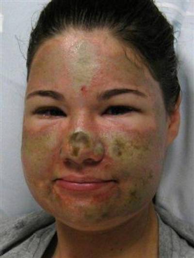 Acid Attack Hoax - On Thursday, Bethany Storro, who had claimed a Black woman she didn’t know threw acid on her face causing irreparable damage, admitted to Oregon police that she had made up the story and that she had actually caused the damage to herself. Police began questioning Storro’s account after examining the pattern of her burn marks (which didn’t match her story), and the non-existent reasons behind why she was wearing sunglasses (which protected her sight from the acid) at night.