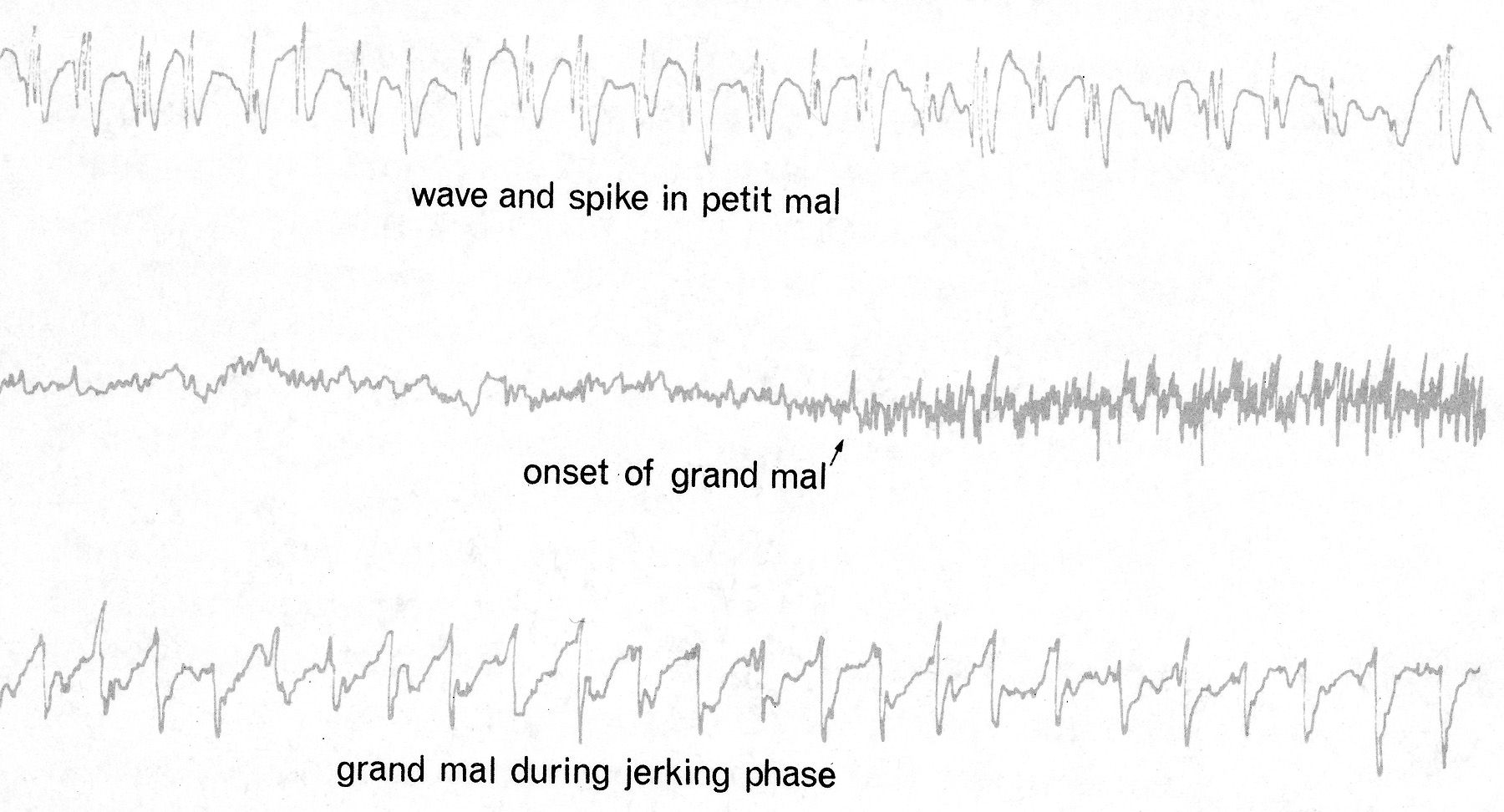 Grand Mal Seizures Image 6 from The 411 on Epilepsy BET