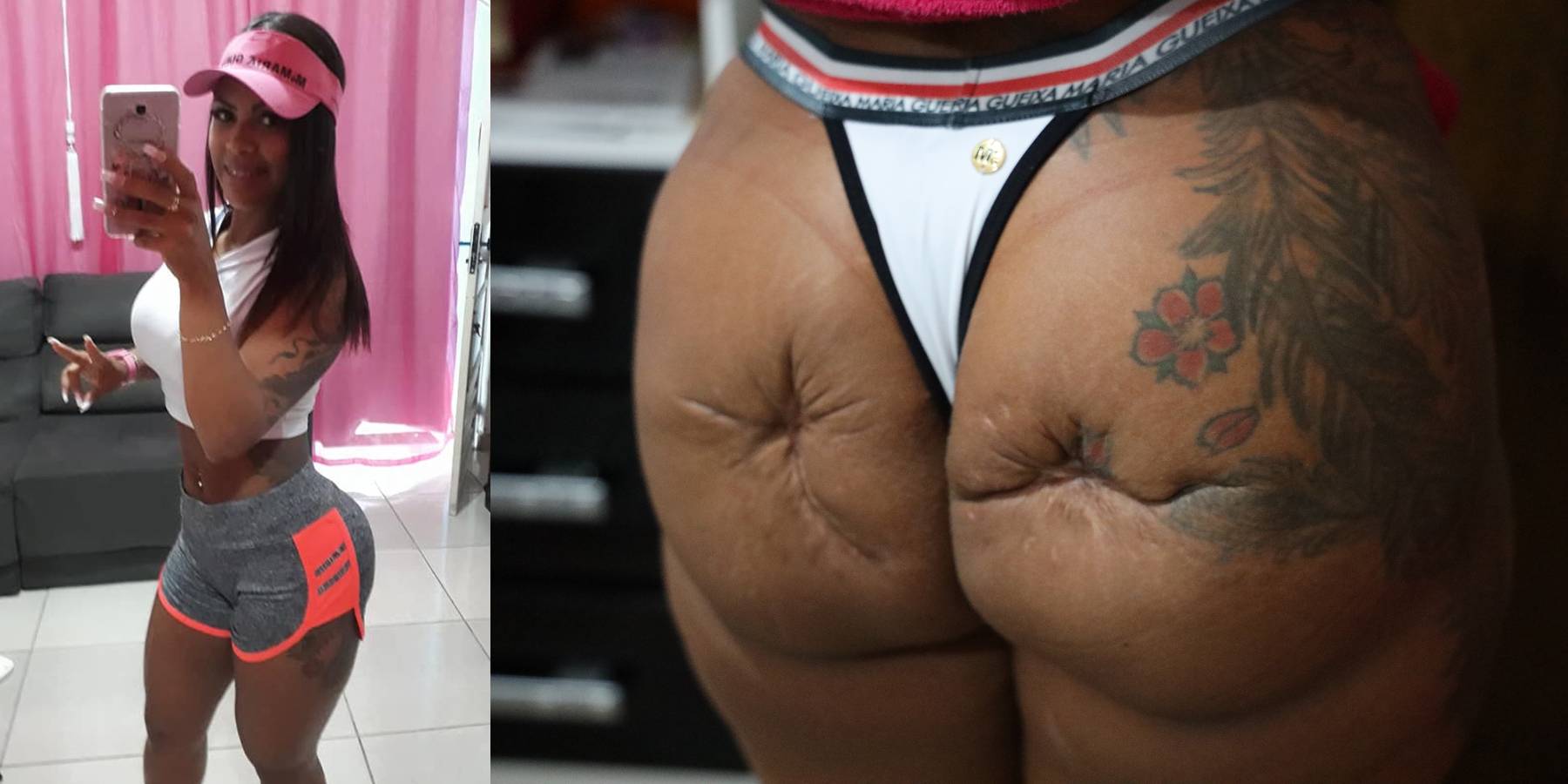 This Brazilian Woman Is Left Disfigured With Crater-like Scars After  Silicone Butt Injections Go Horribly Wrong | News | BET