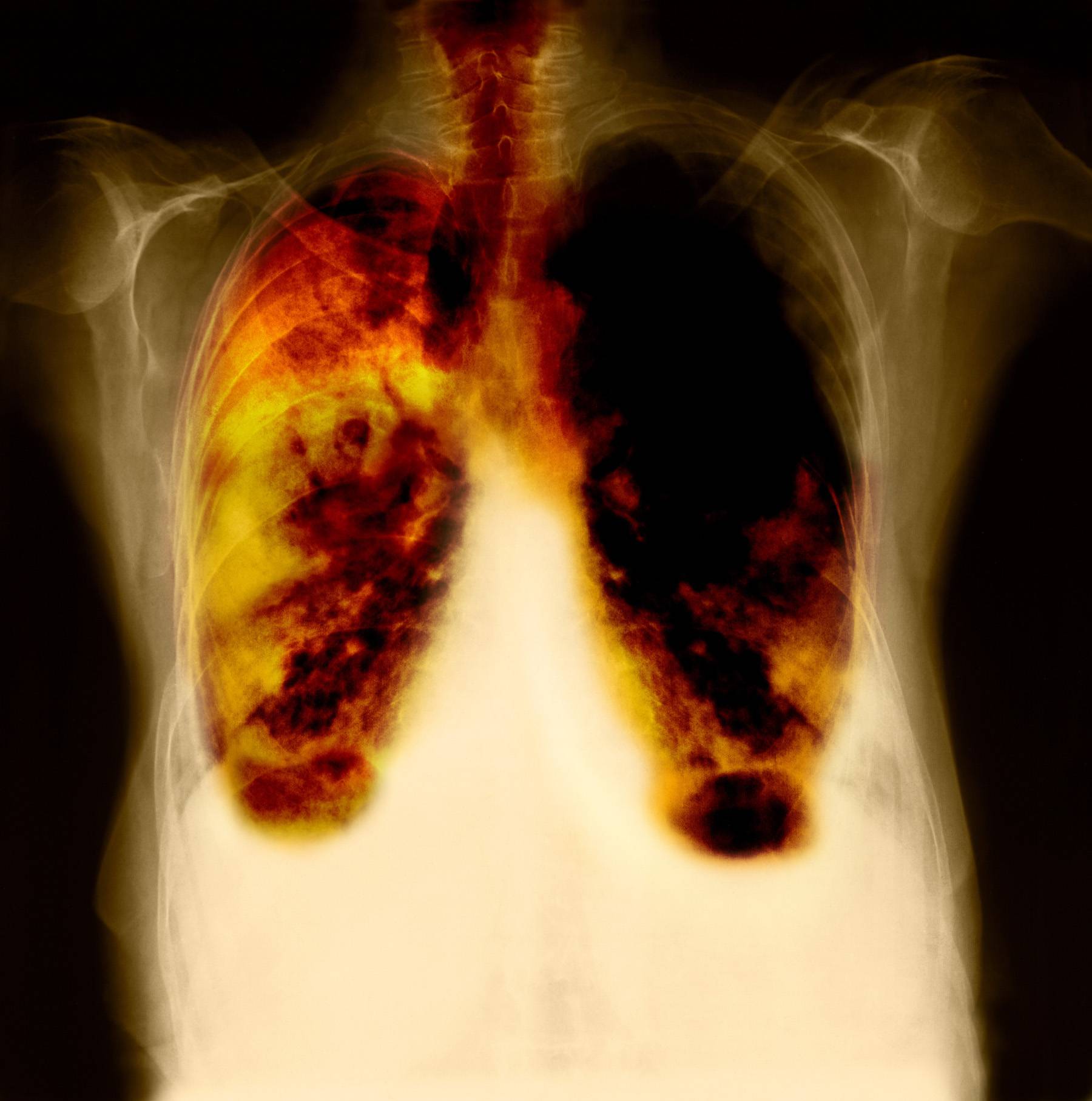 Lung Cancer: Four Things Blacks Need to Know | News | BET