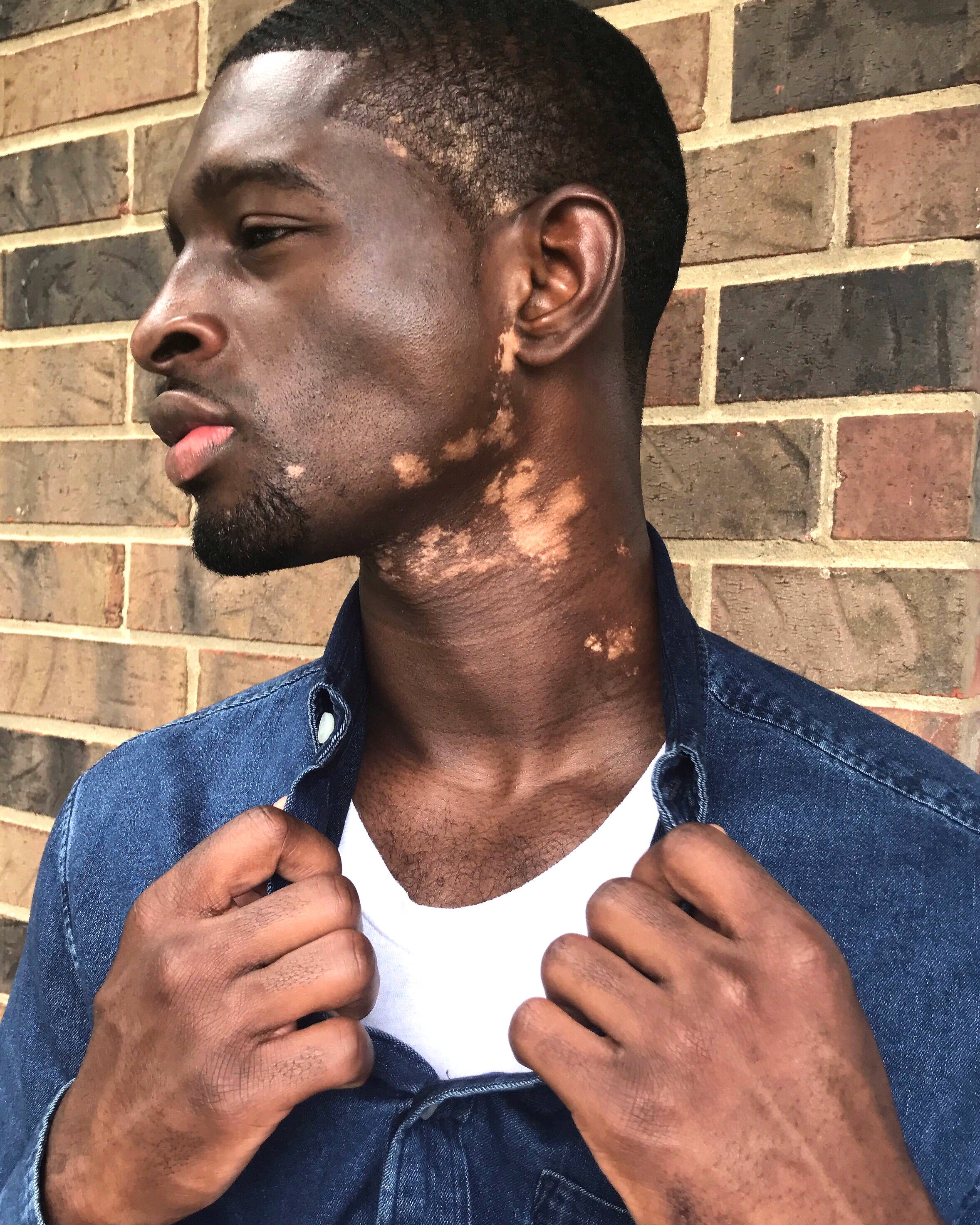 This Male Model Got Vitiligo in the Middle of His Career and He's Still