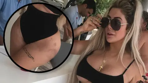 Chloe Ferry Displays Bruising On Her Body As Fans Speculate More Plastic Surgery 