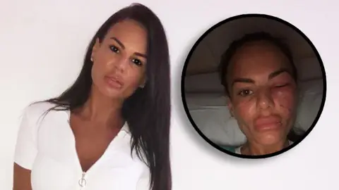 Geordie Shore's Chantelle Connelly gets spider bite and is sent to hopsital