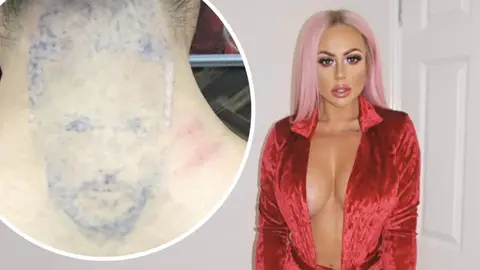 Holly Hagan gets her tattoo of Kyle Christie's face removed.