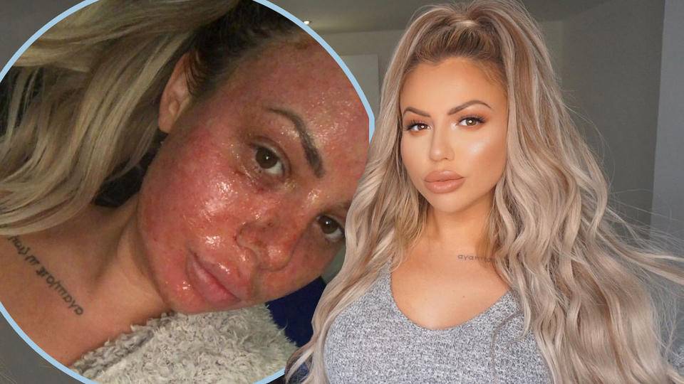 Holly Hagan Shares Healing Process Following Invasive Skin