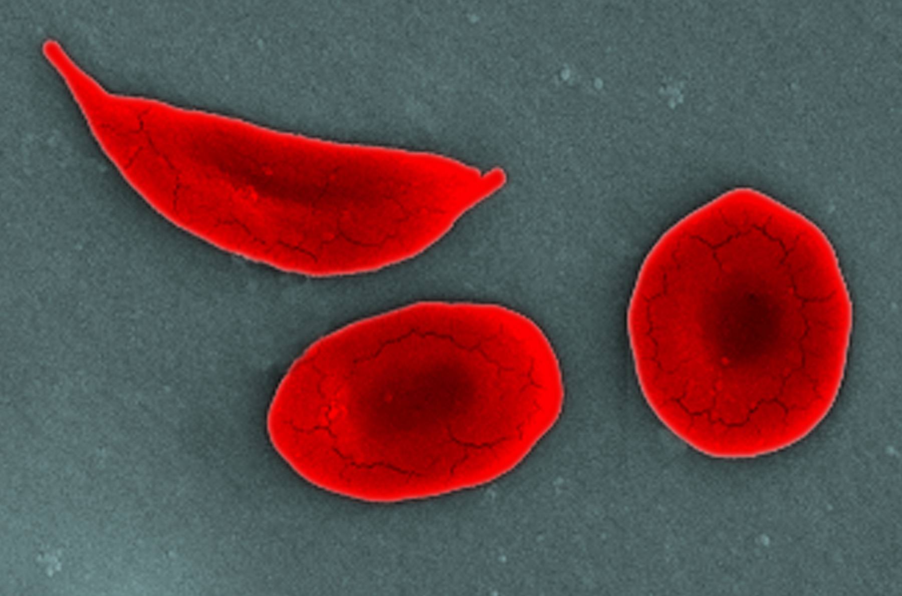 What Is Sickle Cell Disease?