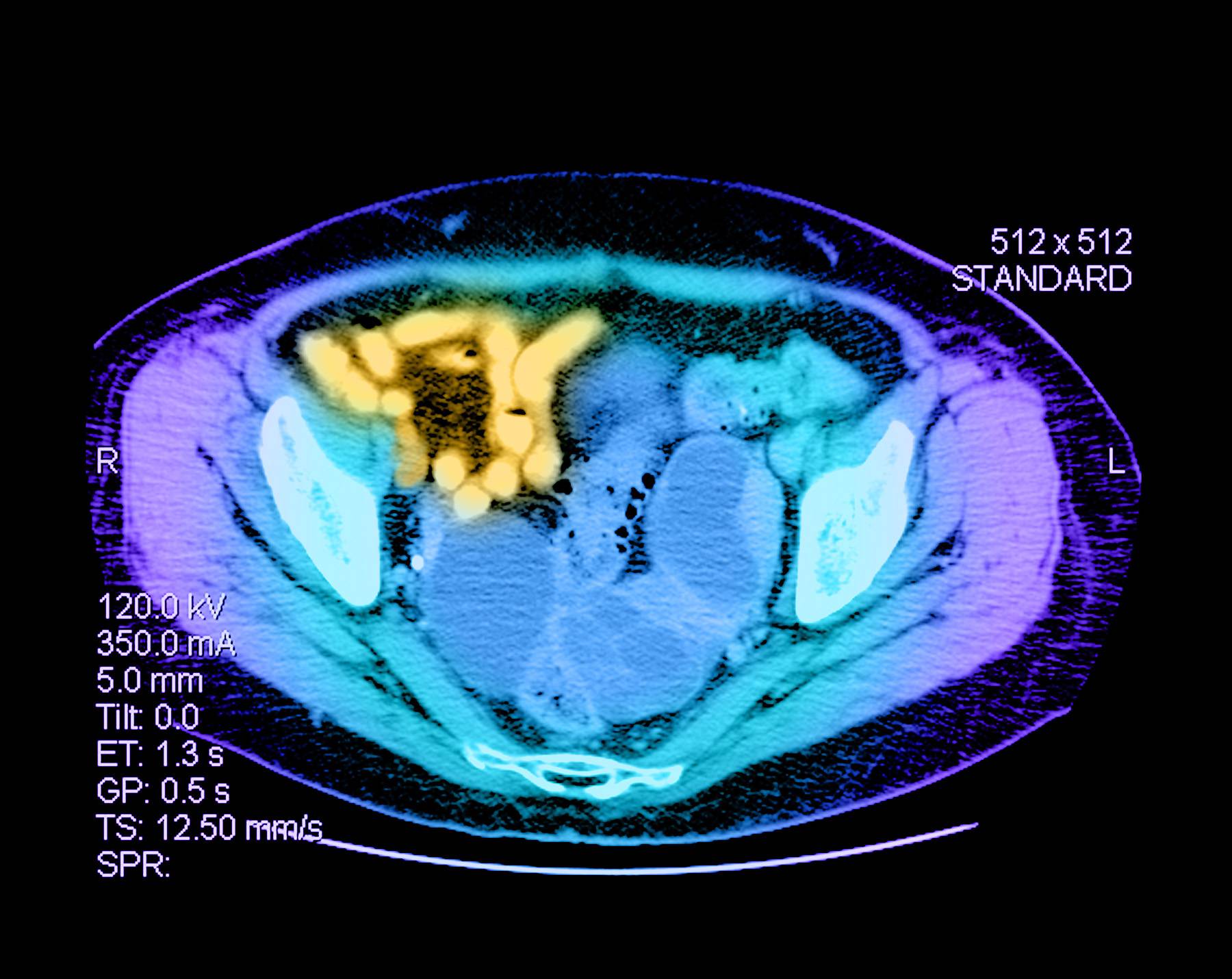 The Four Stages of Ovarian Cancer