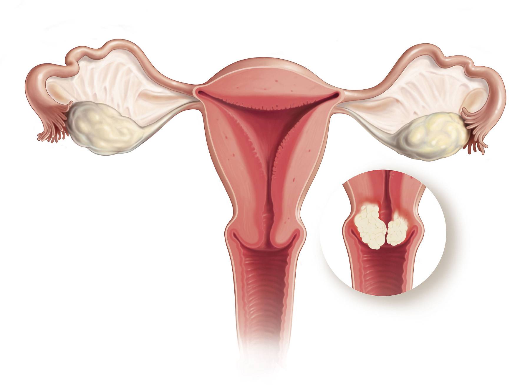 HPV and Cervical Cancer  